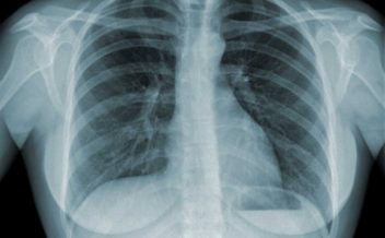 beneficios da fisioterapia respiratoria