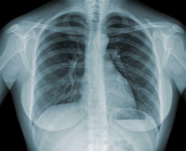 beneficios da fisioterapia respiratoria