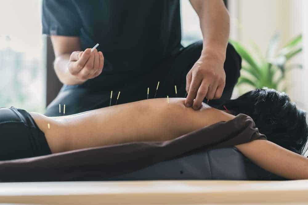 Beneficios da acupuntura